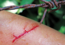 Ferite a caccia: attenzione al tetano Ferite a caccia: attenzione al tetano